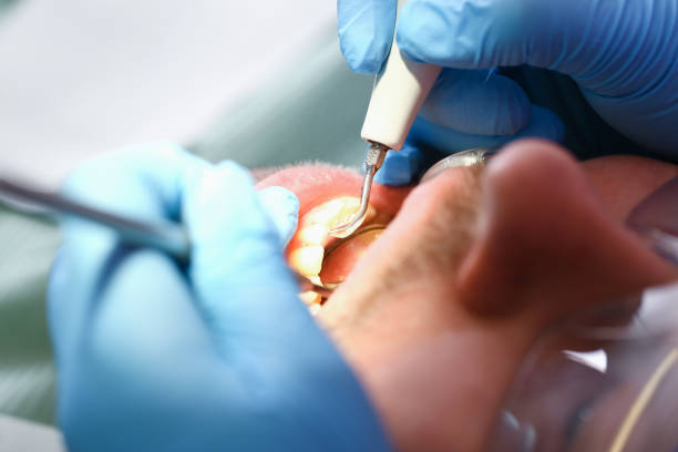 Best Emergency Tooth Extraction in Byron, IL